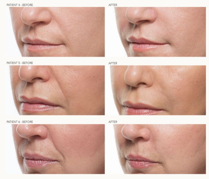 3 female Bellafill patients faces - before and after treatment