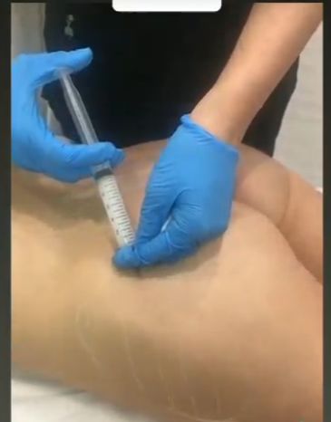 a beautician hands in blue gloves with a large syringe during injection in a buttock 