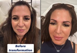 a woman in her 40s before and after a complex filler face treatment including under eye filler procedure